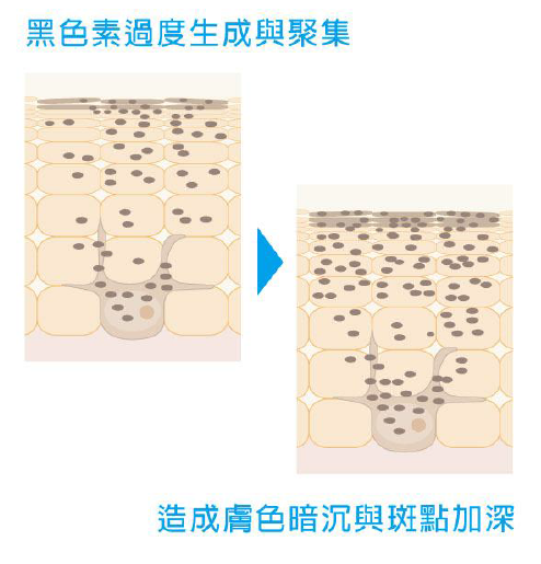 黑色素過度生成與聚集,會造成膚色暗沉與斑點加深